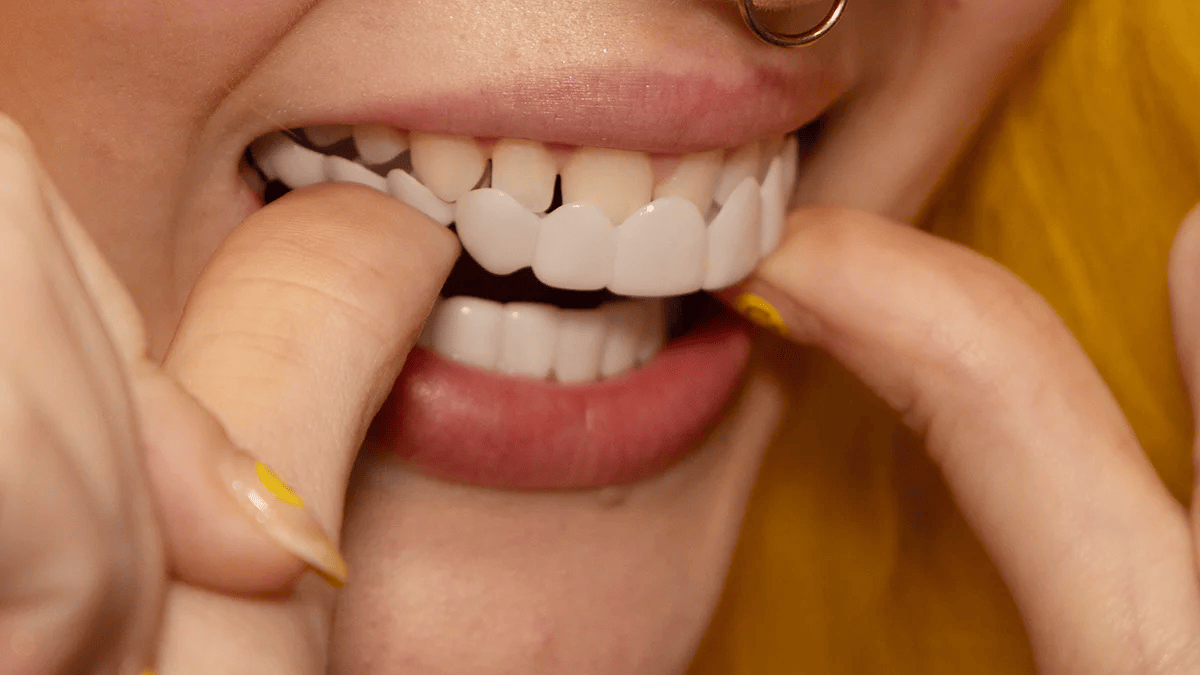 Snap-On Veneers for Upper and Lower Teeth for an Instant Natural Smile