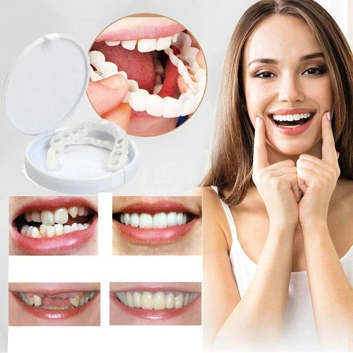 Snap-On Veneers for Upper and Lower Teeth for an Instant Natural Smile