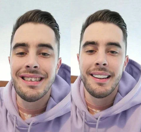 Snap-On Veneers for Upper and Lower Teeth for an Instant Natural Smile