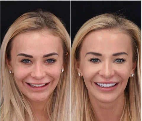 Snap-On Veneers for Upper and Lower Teeth for an Instant Natural Smile