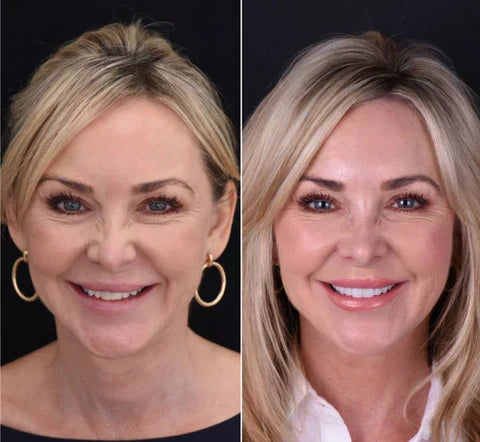Snap-On Veneers for Upper and Lower Teeth for an Instant Natural Smile