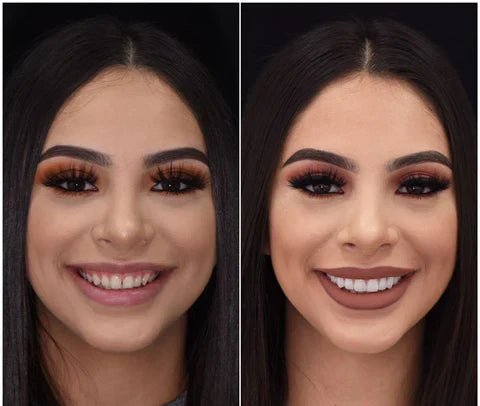 Snap-On Veneers for Upper and Lower Teeth for an Instant Natural Smile